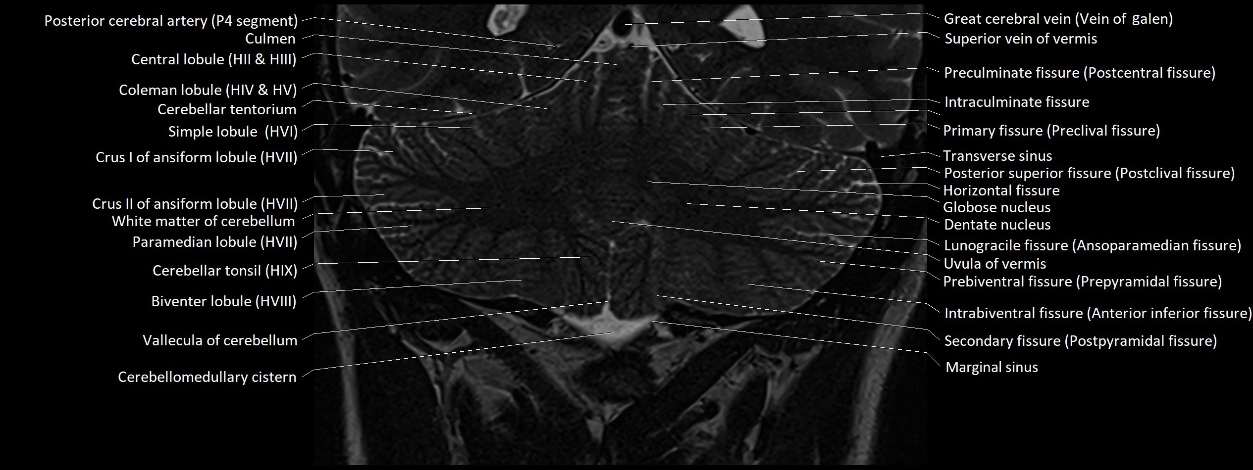 Anatomy of cerebellum coronal cross sectional 3T image 15.webp